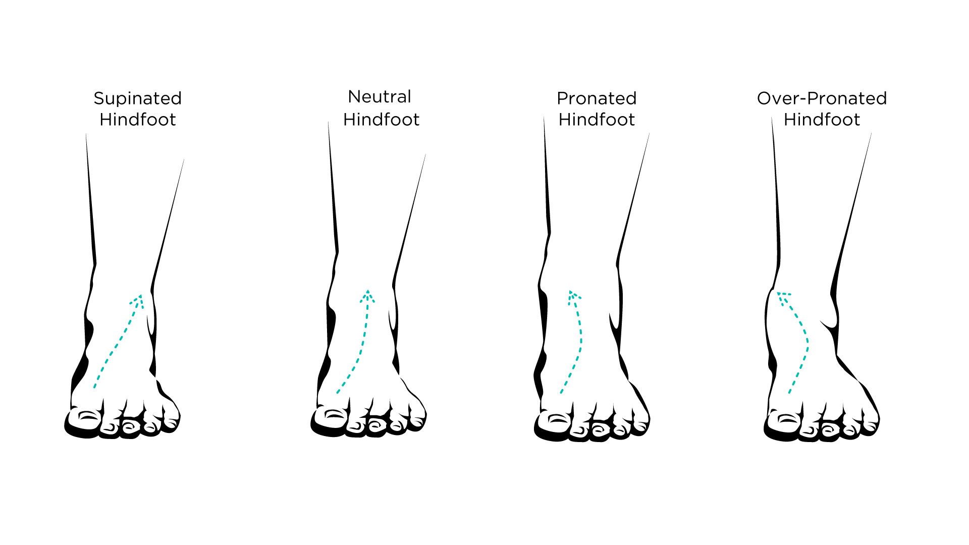 A diagram of the various stages of ankle pronation. Starting from the left, the stages are Supinated Hindfoot, Neutral Hindfoot, Pronated Hindfoot, Overpronated Hindfoot. 
